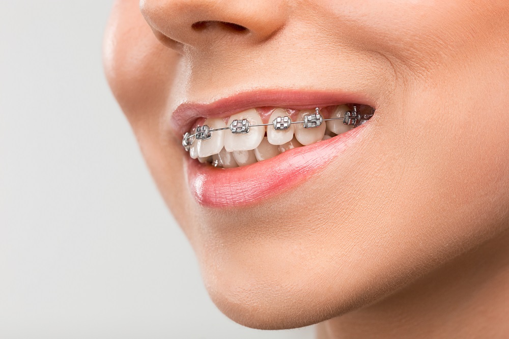 teeth-braces.jpg